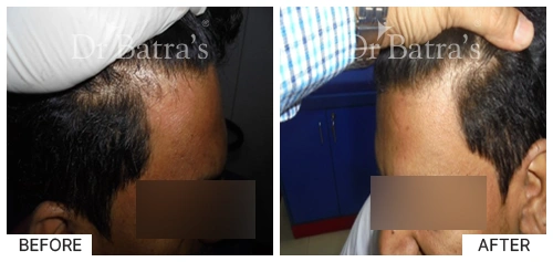 Hair Falling Treatment